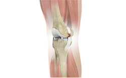 Medial Collateral Ligament MCL Injury Sydney, NSW